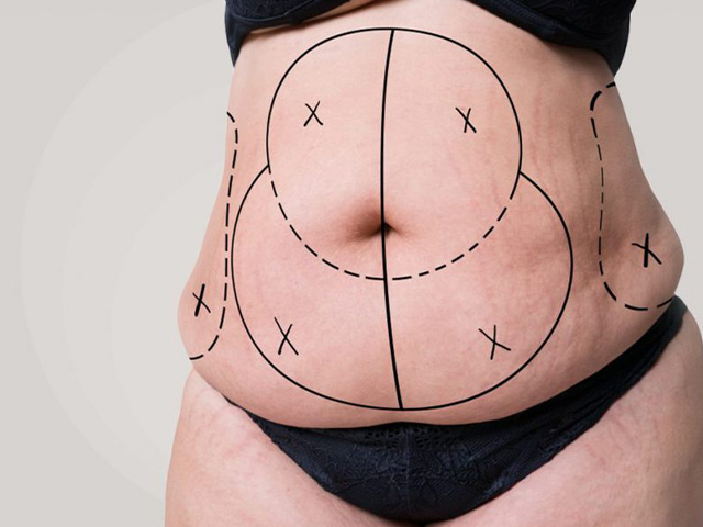 https://www.drdaragiuada.ro/wp-content/uploads/2022/03/A-Reshaping-Miracle-Tummy-Tuck.jpg
