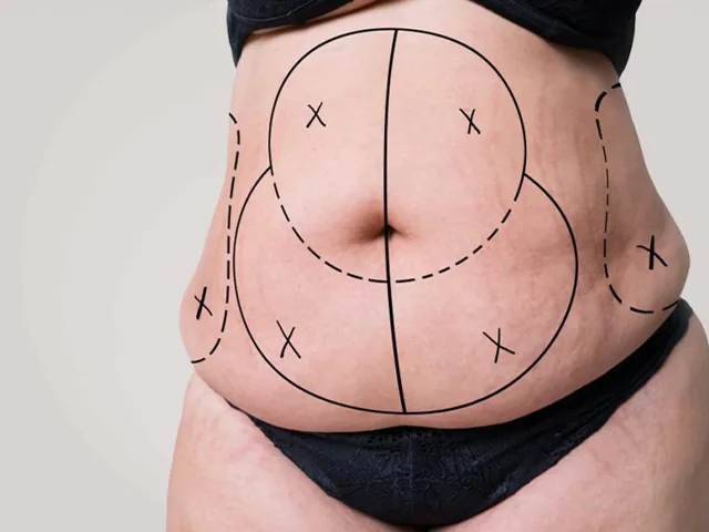 Abdominoplastia (tummy tuck): ce trebuie să știi