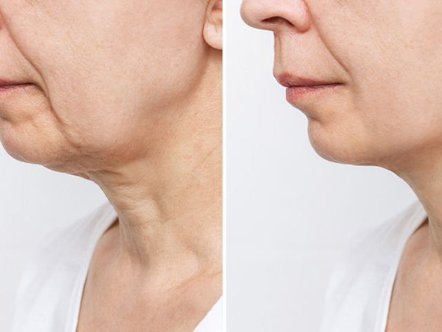 https://www.drdaragiuada.ro/wp-content/uploads/2022/03/What-is-neck-lift-surgery.jpg