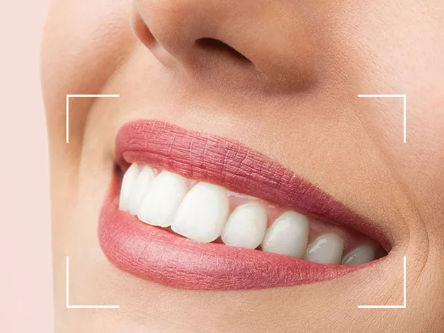 Ce este Hollywood Smile (designul zâmbetului)