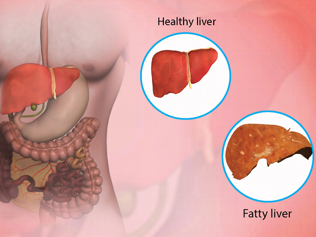 https://www.drdaragiuada.ro/wp-content/uploads/2023/01/what-is-fatty-liver-disease.jpg