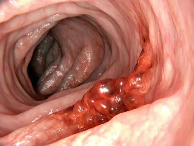 What is Colorectal Cancer