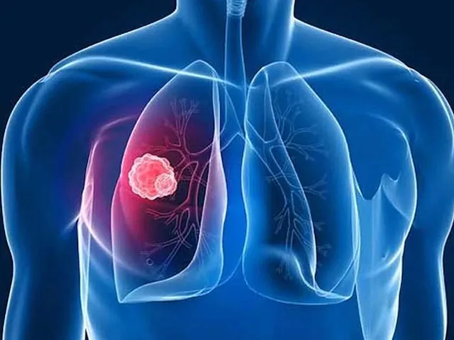 Ce este cancerul pulmonar?