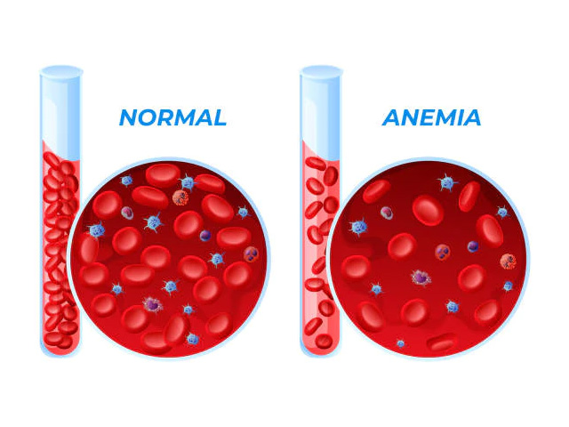 What is Anemia?