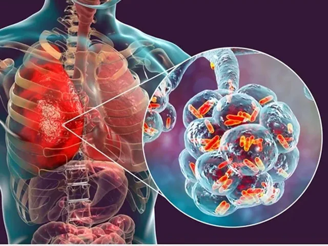 Ce este pneumonia?