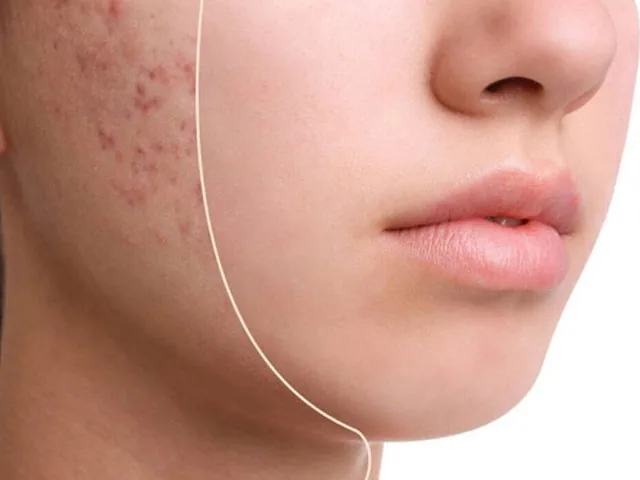 How Do Acne Scars Go Away