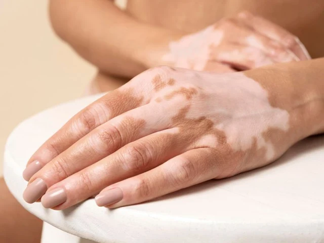 Ce este vitiligo