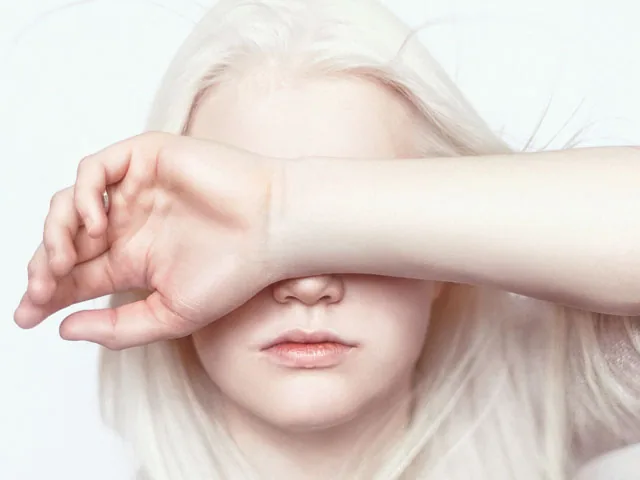 What Is Albinism? How To Take Care Of An Albino Person?